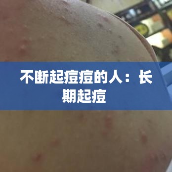 不斷起痘痘的人:長期起痘