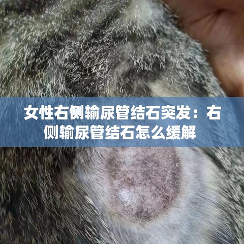 女性右側輸尿管結石突發：右側輸尿管結石怎么緩解 