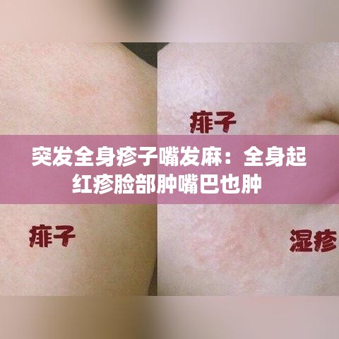 突發(fā)全身疹子嘴發(fā)麻:全身起紅疹臉部腫嘴巴也腫