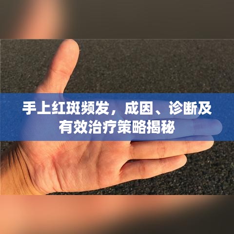 手上紅斑頻發(fā)，成因、診斷及有效治療策略揭秘