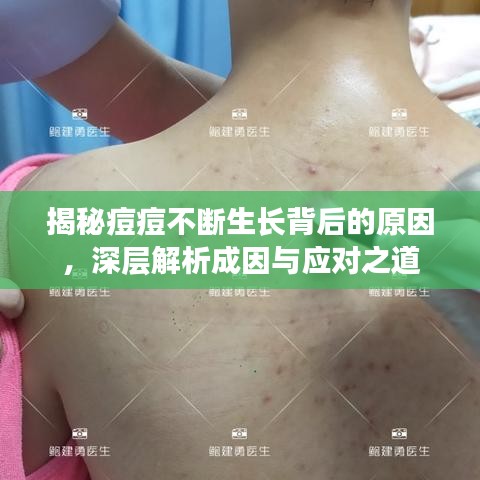 揭秘痘痘不斷生長背后的原因，深層解析成因與應對之道