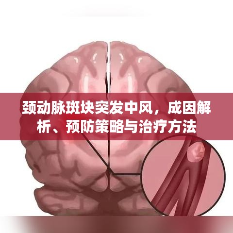 頸動脈斑塊突發(fā)中風(fēng)，成因解析、預(yù)防策略與治療方法